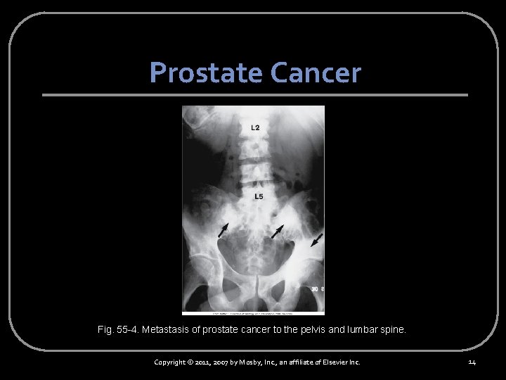 Prostate Cancer Fig. 55 -4. Metastasis of prostate cancer to the pelvis and lumbar