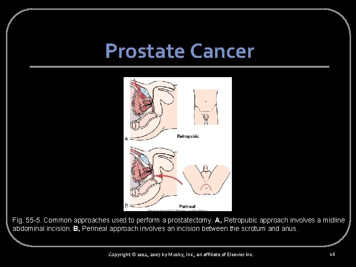 Prostate Cancer Fig. 55 -5. Common approaches used to perform a prostatectomy. A, Retropubic
