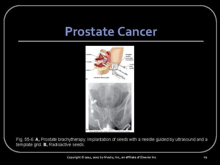 Prostate Cancer Fig. 55 -6. A, Prostate brachytherapy. Implantation of seeds with a needle