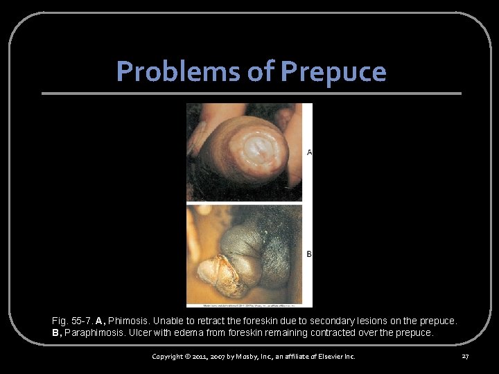 Problems of Prepuce Fig. 55 -7. A, Phimosis. Unable to retract the foreskin due