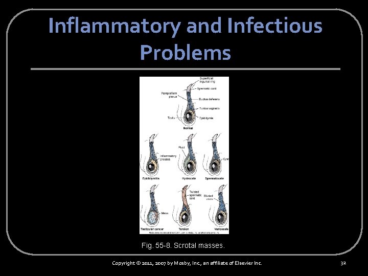 Inflammatory and Infectious Problems Fig. 55 -8. Scrotal masses. Copyright © 2011, 2007 by