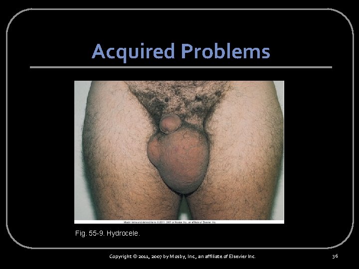 Acquired Problems Fig. 55 -9. Hydrocele. Copyright © 2011, 2007 by Mosby, Inc. ,