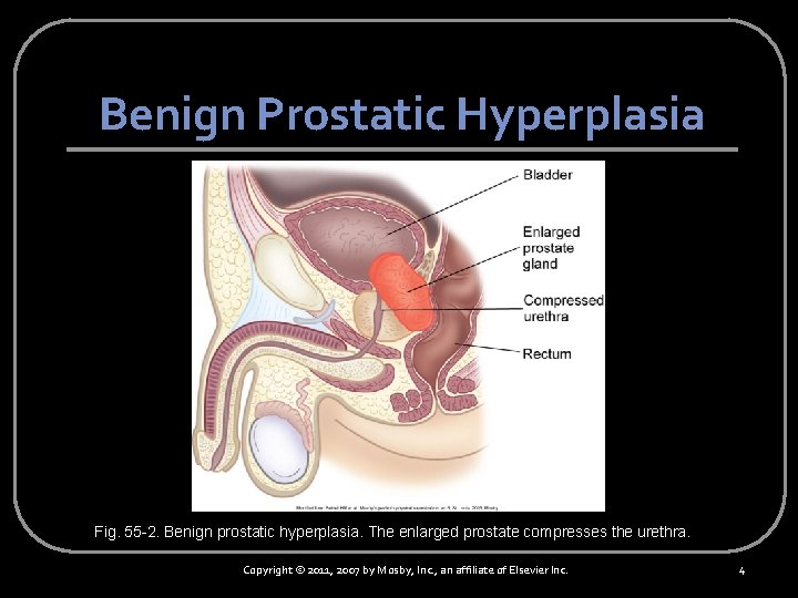 Benign Prostatic Hyperplasia Fig. 55 -2. Benign prostatic hyperplasia. The enlarged prostate compresses the