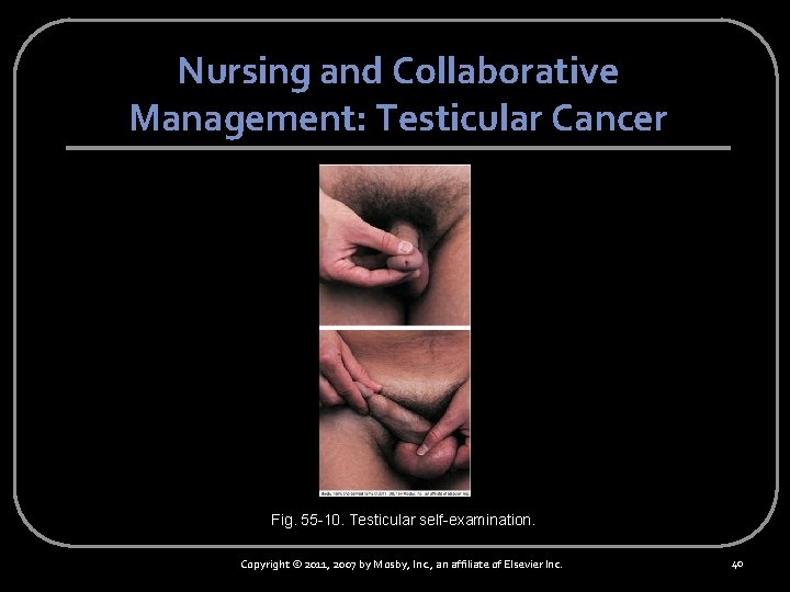 Nursing and Collaborative Management: Testicular Cancer Fig. 55 -10. Testicular self-examination. Copyright © 2011,