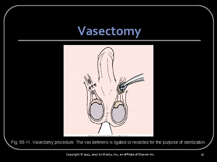 Vasectomy Fig. 55 -11. Vasectomy procedure. The vas deferens is ligated or resected for