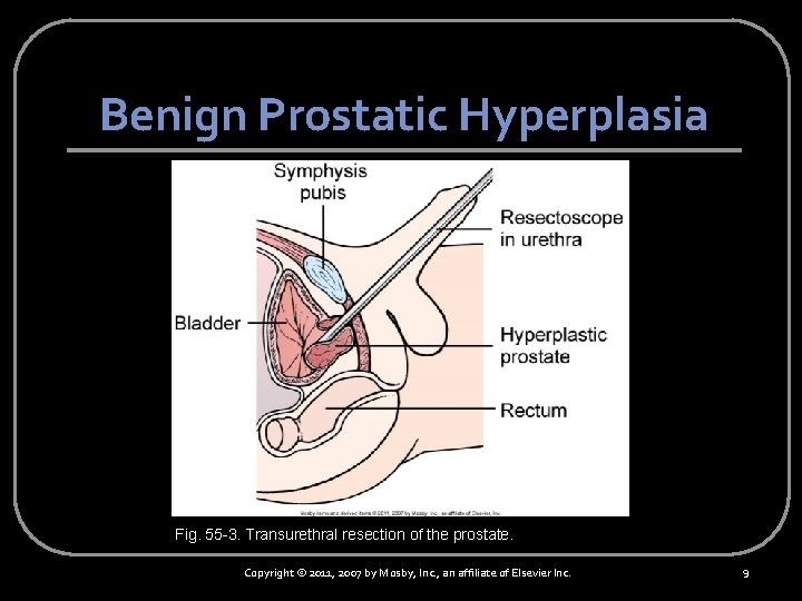 Benign Prostatic Hyperplasia Fig. 55 -3. Transurethral resection of the prostate. Copyright © 2011,