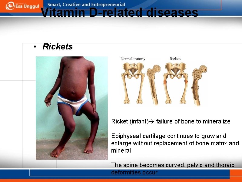 Vitamin D-related diseases • Rickets Ricket (infant) failure of bone to mineralize Epiphyseal cartilage