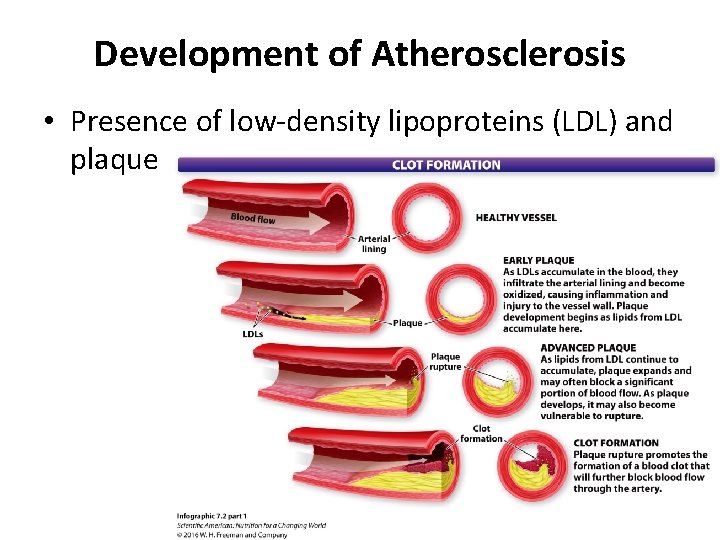 Development of Atherosclerosis • Presence of low-density lipoproteins (LDL) and plaque 