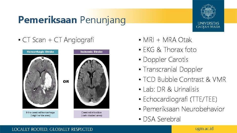Pemeriksaan Penunjang • CT Scan + CT Angiografi • MRI + MRA Otak •