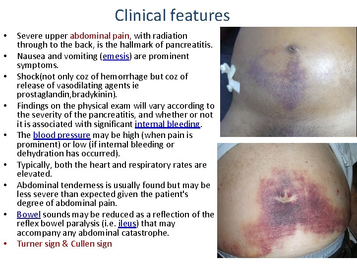 Clinical features • • • Severe upper abdominal pain, with radiation through to the