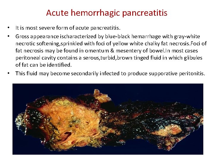 Acute hemorrhagic pancreatitis • It is most severe form of acute pancreatitis. • Gross