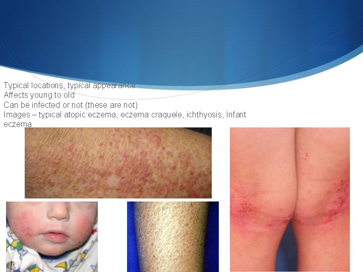 Typical locations, typical appearance Affects young to old Can be infected or not (these