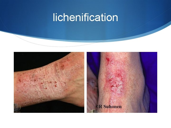 lichenification 