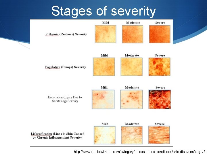 Stages of severity http: //www. coolhealthtips. com/category/diseases-and-conditions/skin-diseases/page/2 