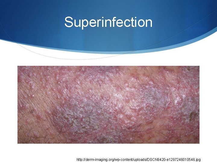 Superinfection http: //derm-imaging. org/wp-content/uploads/DSCN 9420 -e 1297246010546. jpg 