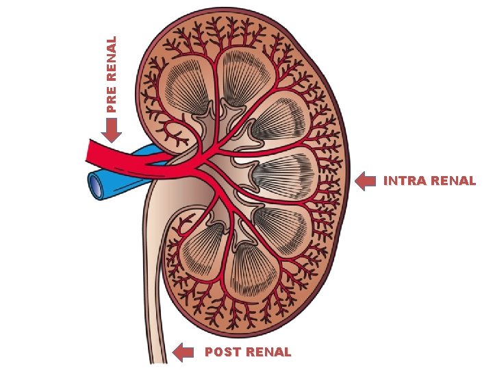 PRE RENAL INTRA RENAL POST RENAL 