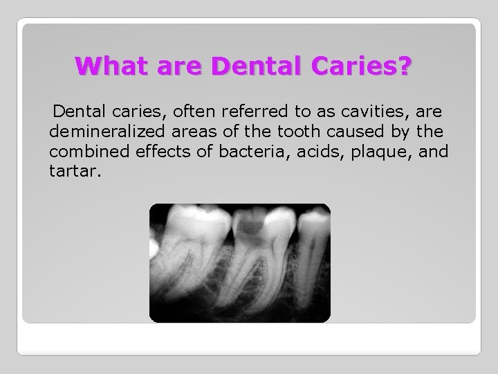 What are Dental Caries? Dental caries, often referred to as cavities, are demineralized areas