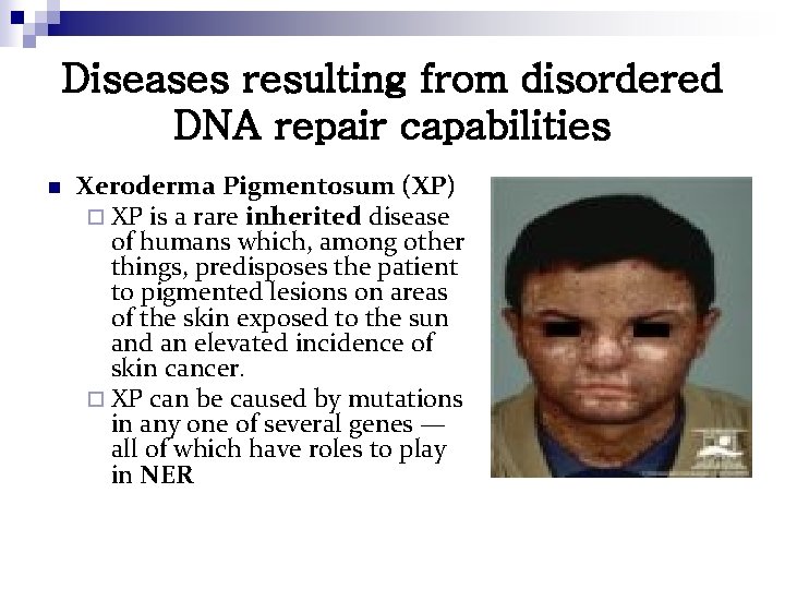 Diseases resulting from disordered DNA repair capabilities n Xeroderma Pigmentosum (XP) ¨ XP is