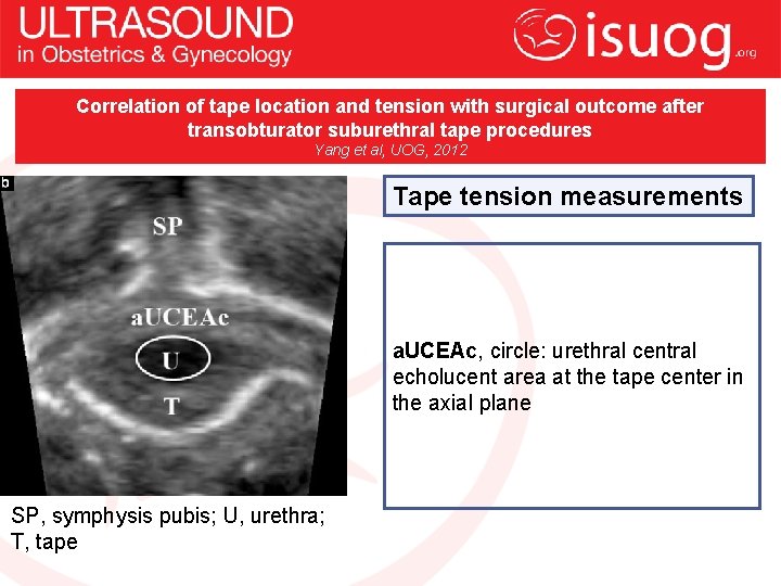 Correlation of tape location and tension with surgical outcome after transobturator suburethral tape procedures
