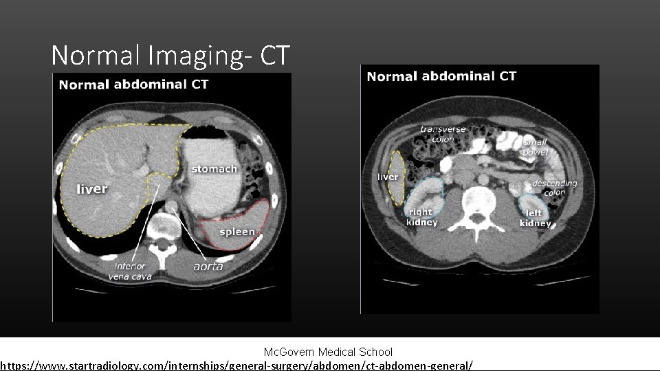 Normal Imaging- CT Mc. Govern Medical School https: //www. startradiology. com/internships/general-surgery/abdomen/ct-abdomen-general/ 