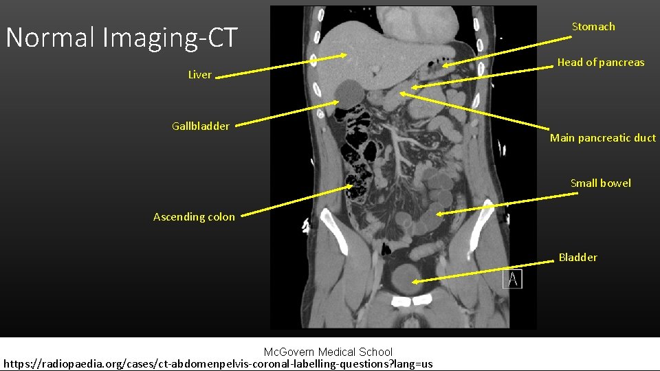 Normal Imaging-CT Stomach Head of pancreas Liver Gallbladder Main pancreatic duct Small bowel Ascending