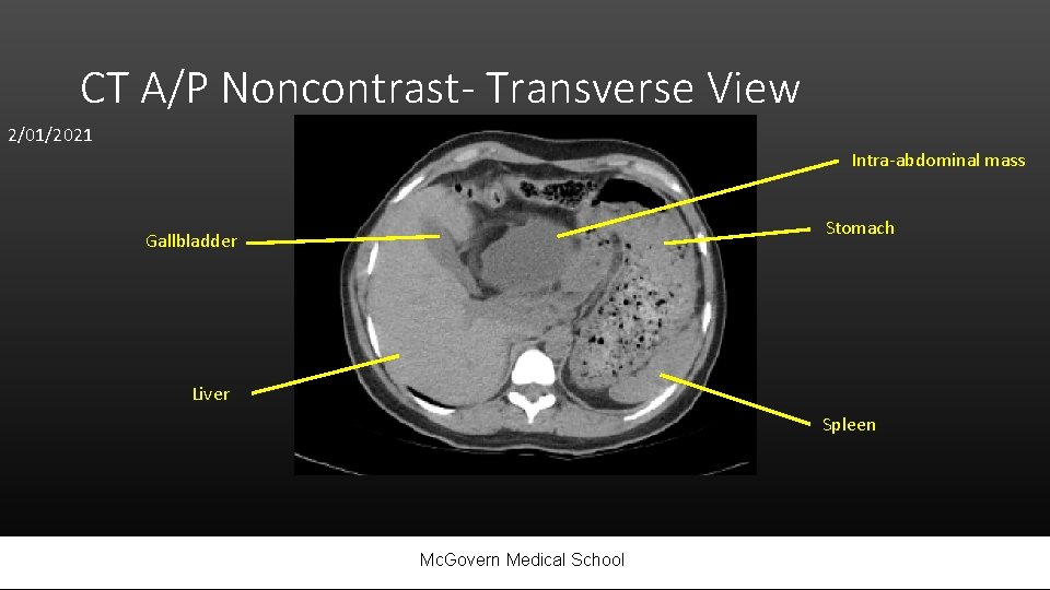 CT A/P Noncontrast- Transverse View 2/01/2021 Intra-abdominal mass Stomach Gallbladder Liver Spleen Mc. Govern