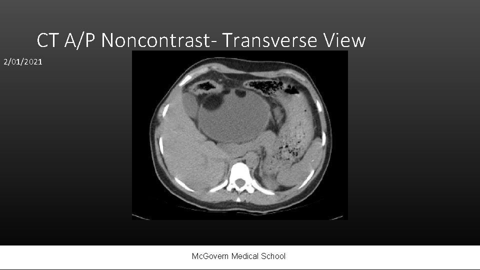 CT A/P Noncontrast- Transverse View 2/01/2021 Mc. Govern Medical School 