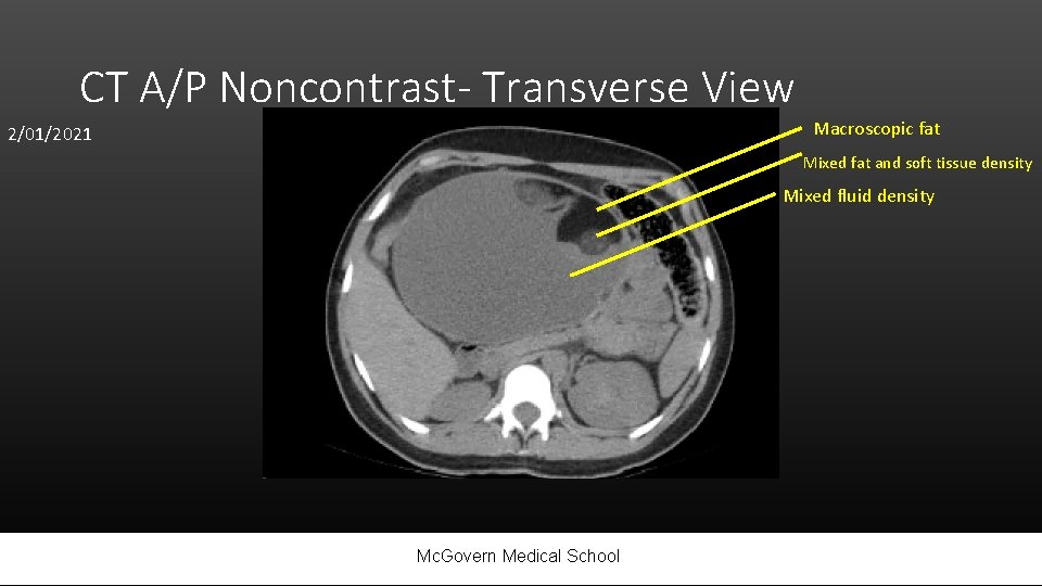 CT A/P Noncontrast- Transverse View Macroscopic fat 2/01/2021 Mixed fat and soft tissue density