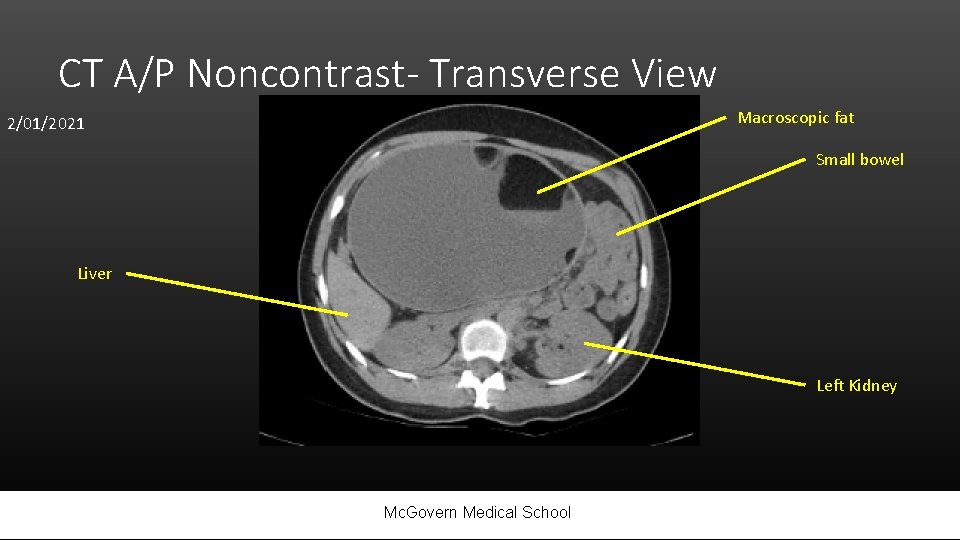 CT A/P Noncontrast- Transverse View Macroscopic fat 2/01/2021 Small bowel Liver Left Kidney Mc.