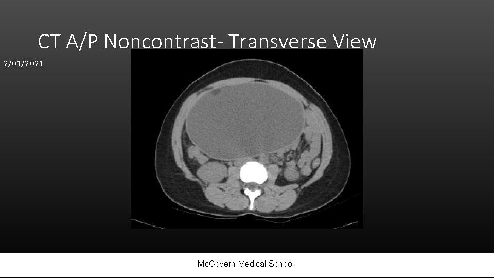 CT A/P Noncontrast- Transverse View 2/01/2021 Mc. Govern Medical School 