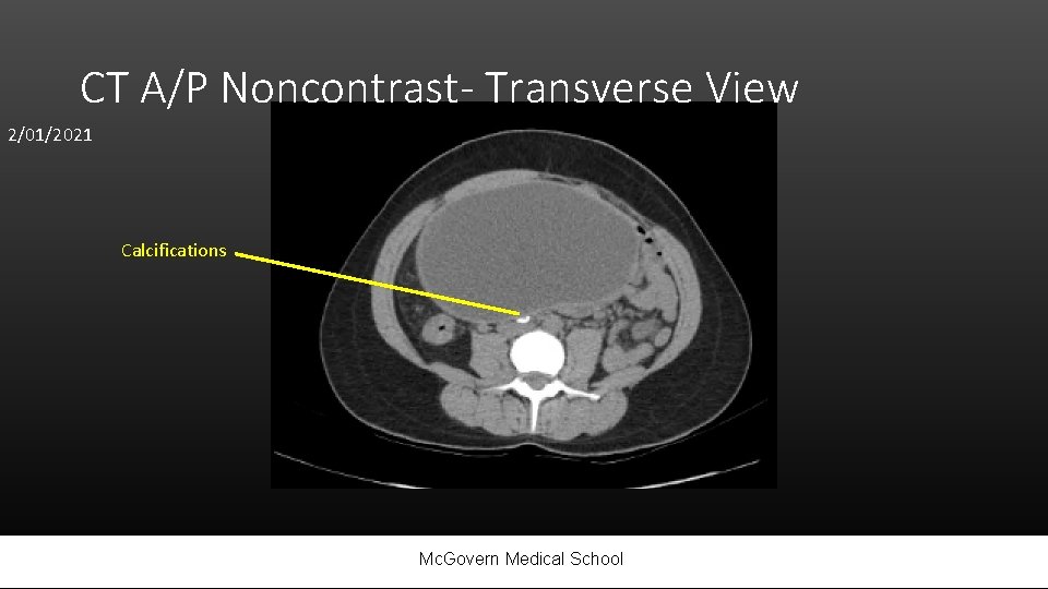 CT A/P Noncontrast- Transverse View 2/01/2021 Calcifications Mc. Govern Medical School 