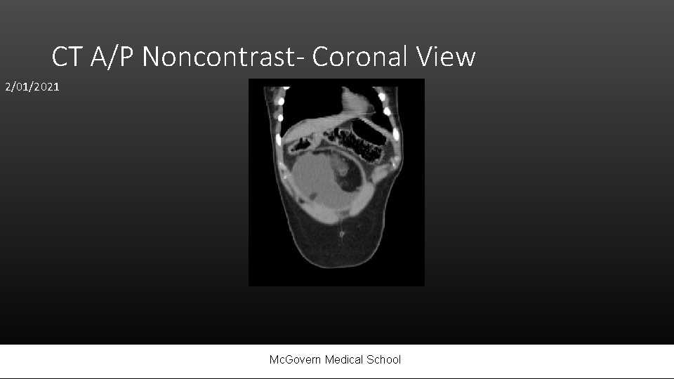 CT A/P Noncontrast- Coronal View 2/01/2021 Mc. Govern Medical School 