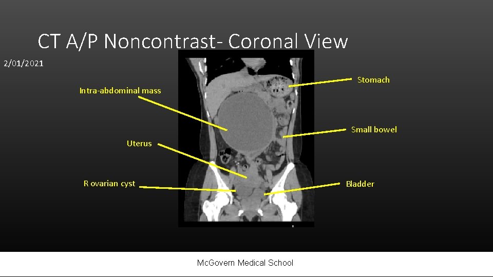 CT A/P Noncontrast- Coronal View 2/01/2021 Stomach Intra-abdominal mass Small bowel Uterus R ovarian