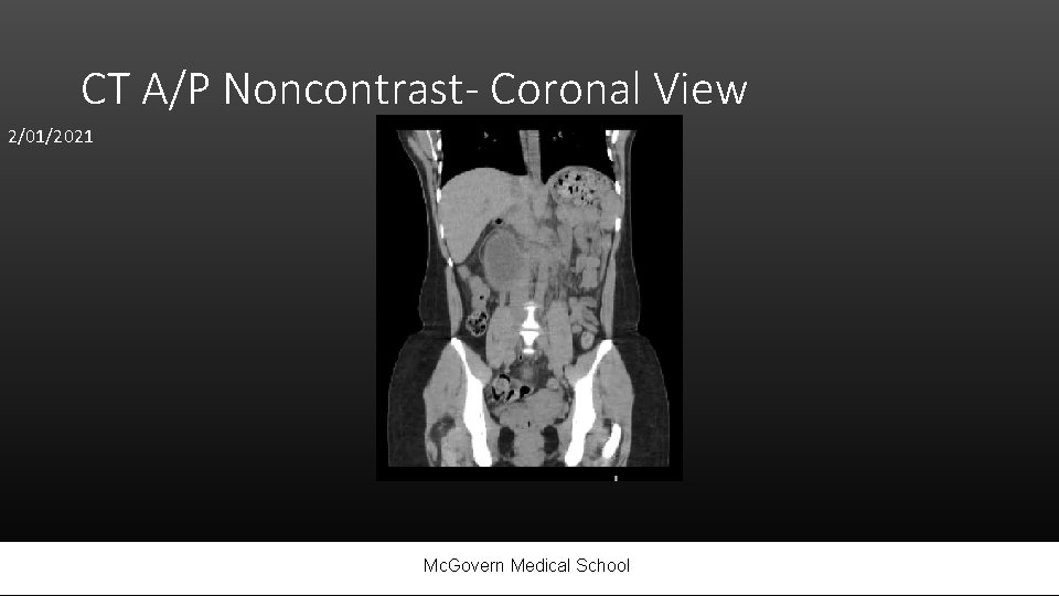CT A/P Noncontrast- Coronal View 2/01/2021 Mc. Govern Medical School 