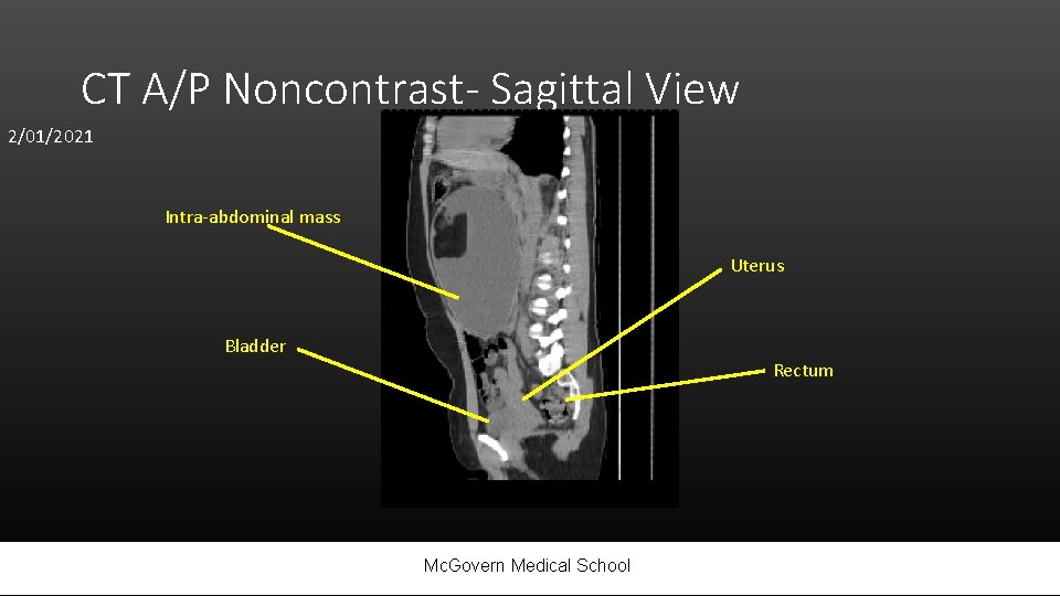 CT A/P Noncontrast- Sagittal View 2/01/2021 Intra-abdominal mass Uterus Bladder Rectum Mc. Govern Medical