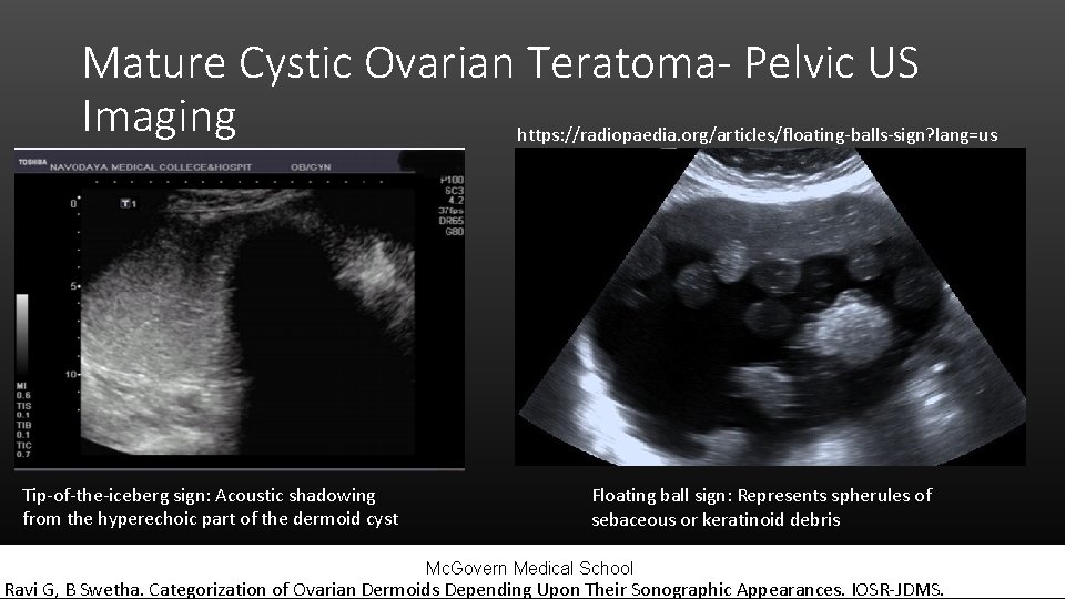 Mature Cystic Ovarian Teratoma- Pelvic US Imaging https: //radiopaedia. org/articles/floating-balls-sign? lang=us Tip-of-the-iceberg sign: Acoustic