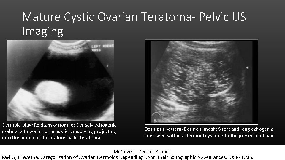 Mature Cystic Ovarian Teratoma- Pelvic US Imaging Dermoid plug/Rokitansky nodule: Densely echogenic nodule with