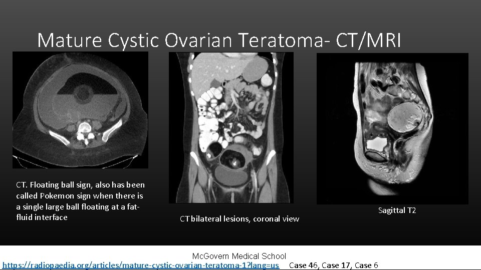 Mature Cystic Ovarian Teratoma- CT/MRI CT. Floating ball sign, also has been called Pokemon