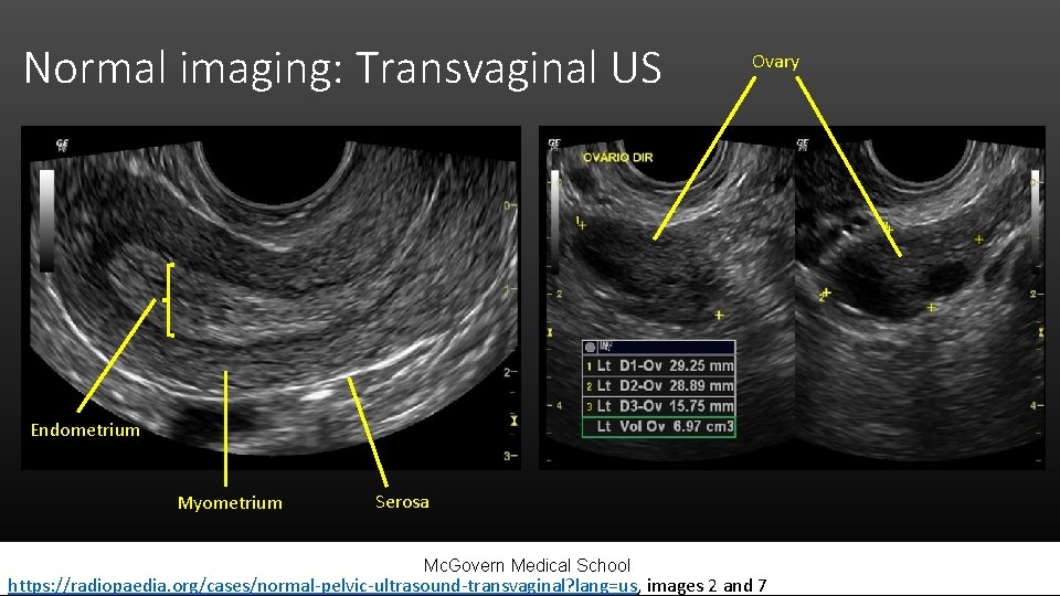 Normal imaging: Transvaginal US Ovary Endometrium Myometrium Serosa Mc. Govern Medical School https: //radiopaedia.