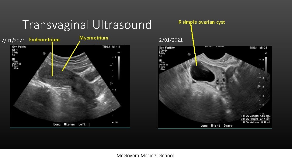 Transvaginal Ultrasound 2/01/2021 Endometrium Myometrium R simple ovarian cyst 2/01/2021 Mc. Govern Medical School
