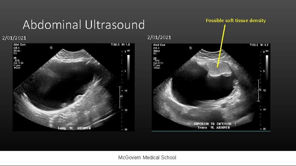 Abdominal Ultrasound 2/01/2021 Possible soft tissue density 2/01/2021 Mc. Govern Medical School 