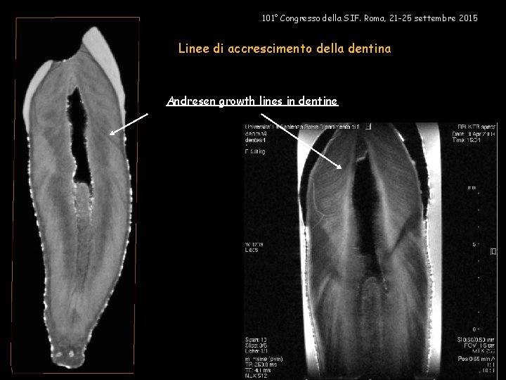 101° Congresso della SIF. Roma, 21 -25 settembre 2015 Linee di accrescimento della dentina