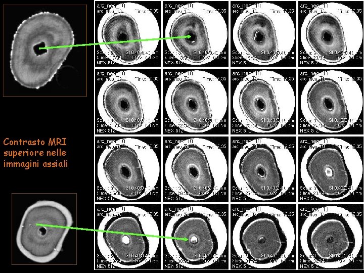 Contrasto MRI superiore nelle immagini assiali 