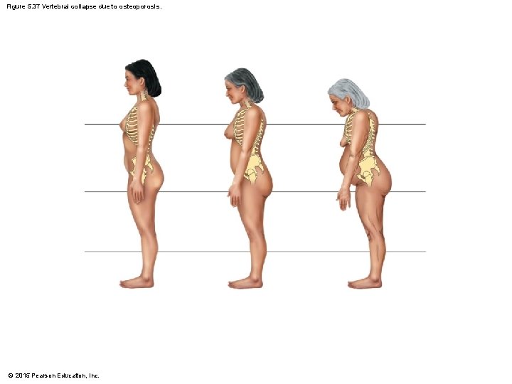 Figure 5. 37 Vertebral collapse due to osteoporosis. © 2015 Pearson Education, Inc. 