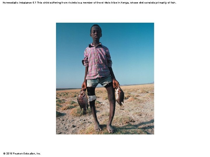 Homeostatic Imbalance 5. 1 This child suffering from rickets is a member of the