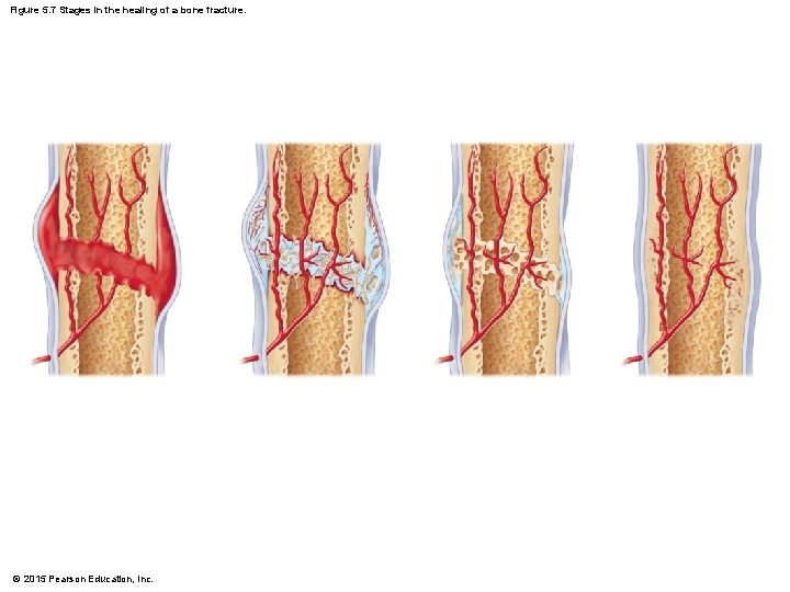 Figure 5. 7 Stages in the healing of a bone fracture. © 2015 Pearson