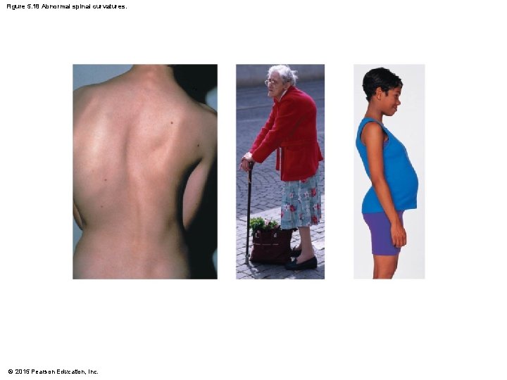 Figure 5. 18 Abnormal spinal curvatures. © 2015 Pearson Education, Inc. 