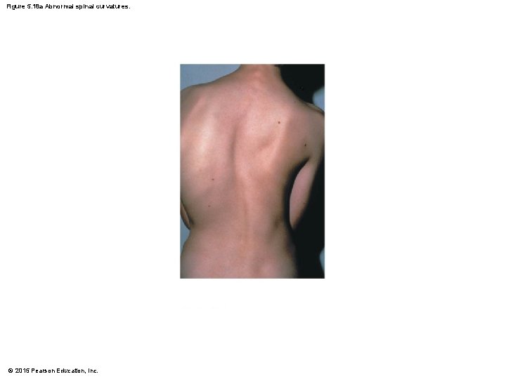Figure 5. 18 a Abnormal spinal curvatures. © 2015 Pearson Education, Inc. 