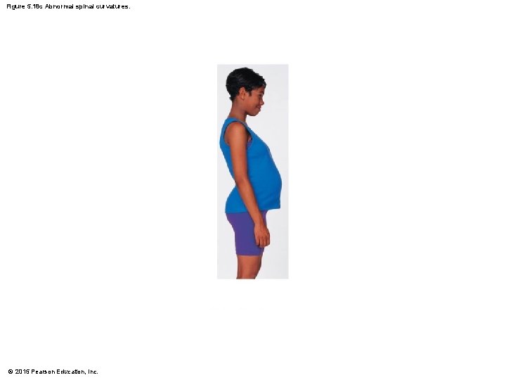 Figure 5. 18 c Abnormal spinal curvatures. © 2015 Pearson Education, Inc. 