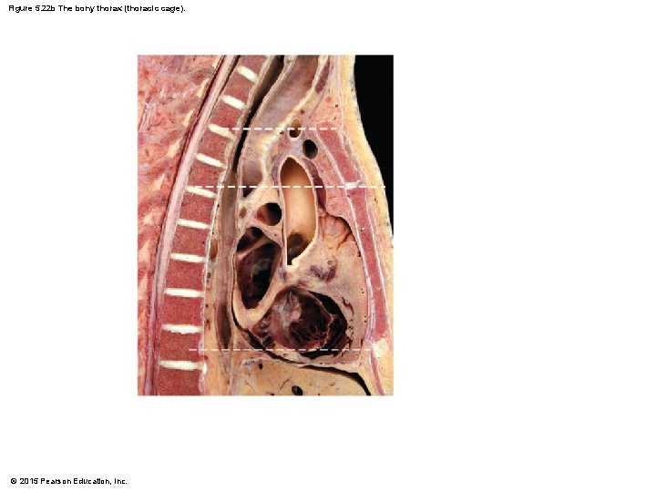 Figure 5. 22 b The bony thorax (thoracic cage). © 2015 Pearson Education, Inc.